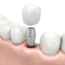 implant example for implant page